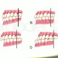 Consideraciones Oclusales En Implantes Dentales