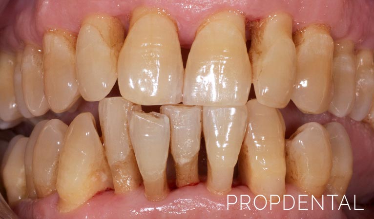 Cómo afecta la periodontitis en la salud general