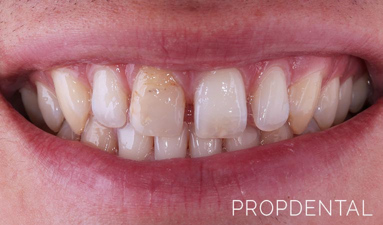 Diastema o dientes separados las claves Clínicas PropDental Madrid y