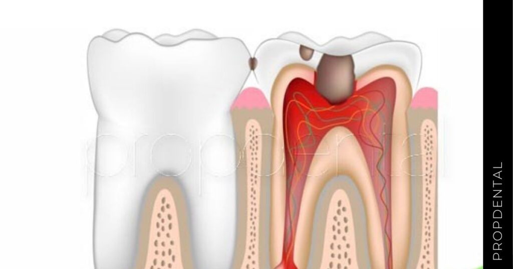 Qué es la pulpitis dental Tratamiento de la pulpitis en una muela