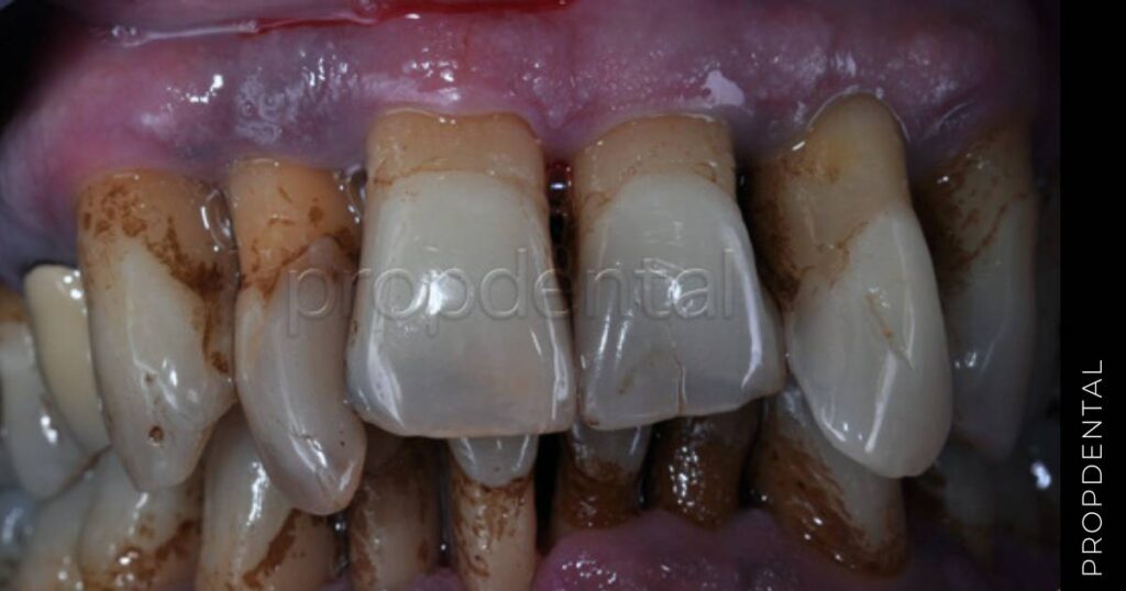 Qué es la piorrea Precio tratar la piorrea en Barcelona y Madrid