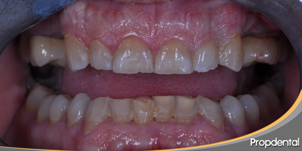 Clinica Corica - Bruxismo, para que no te suenen los dientes en la noche.  El bruxismo es apretar o rechinar los dientes causando desgaste dental. Se  hace de manera inconsciente de noche
