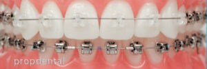 precio brackets damon Barcelona