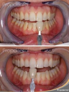 blanqueamiento dental con férulas