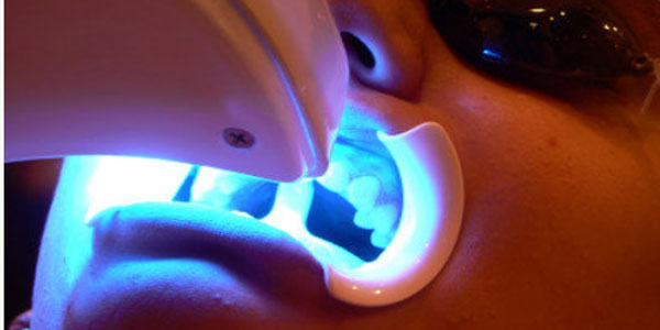 Resultado de imagen para blanqueamiento dental laser