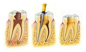 tratamiento de la pulpitis irreversible