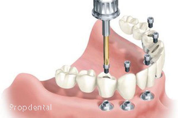 Prótesis E Implantes; Implantes Artificiales; Prótesis