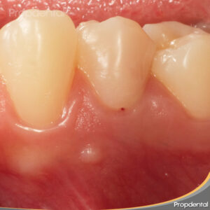 fistula por infección dental