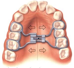 expansor de ortodoncia