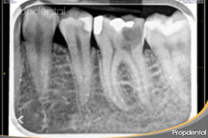 radiografia periapical