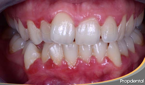 Clasificación de las enfermedades periodontales