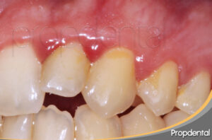 Clasificación de la gingivitis