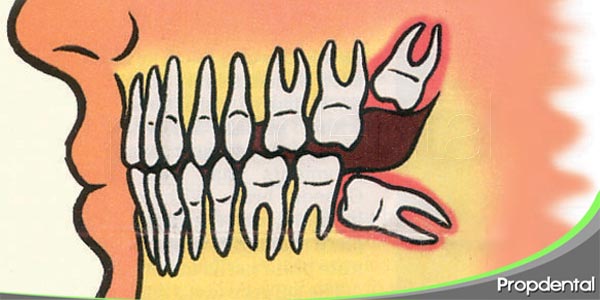 Patología Del Tercer Molar Retenido