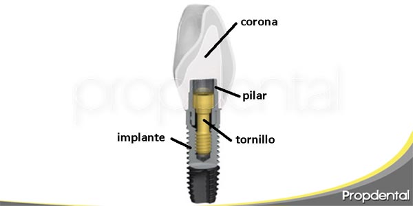 Resultado de imagen de imagenes parte implantes