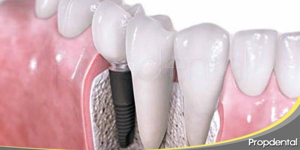 Colocacion De Los Implantes Dentales Fases Del Implante Dental