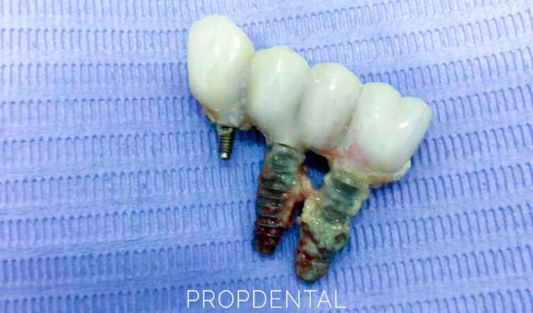 Fracaso De Implantes Dentales ¿qué Hacer Si Falla Un Implante Dental 4275