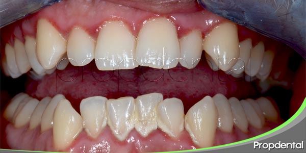 ¿Cuáles Son Las Soluciones Para El Apiñamiento Dental?