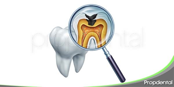 Resultado de imagen para diagnostico de las caries