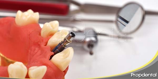 Colocacion De Los Implantes Dentales Fases Del Implante Dental