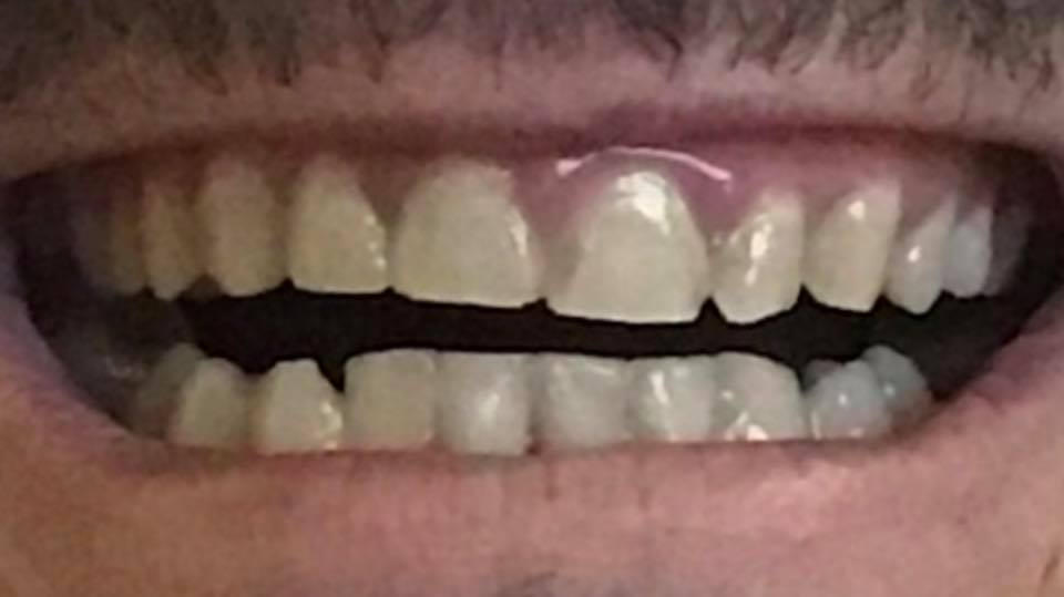 Porque Tengo Los Dientes De Arriba Mas Adelante