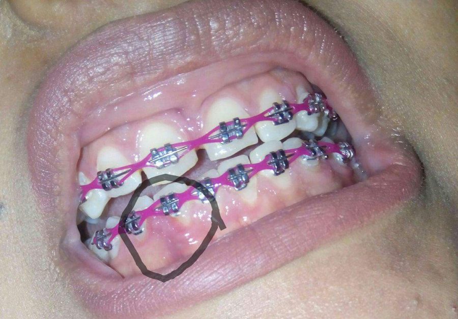 Que comer cuando te duelen los dientes por los brackets salonmarilyn-vb.cz