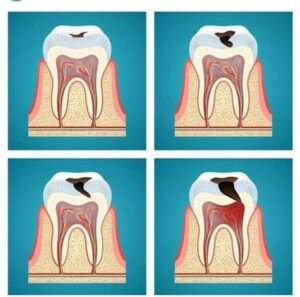 Como Es La Evoluci N De La Caries Dental Y Como Solucionarla