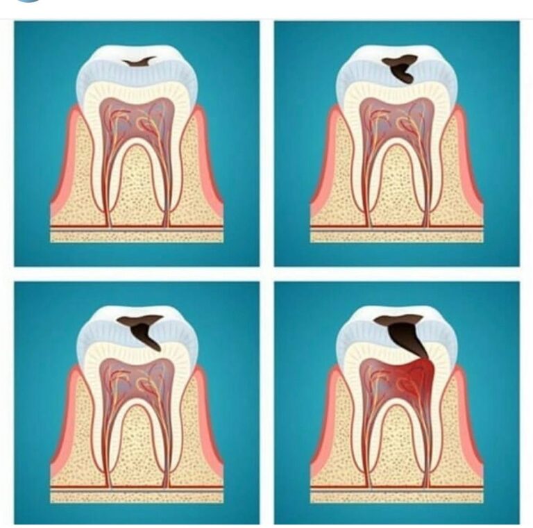 como es la evolución de la caries dental y como solucionarla