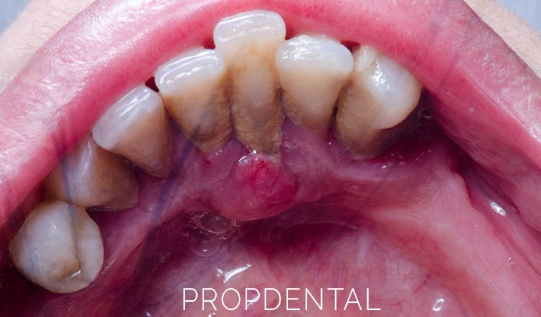 Tipos De Infecciones Dentales ¿como Tratar Una Infección De Boca 3201