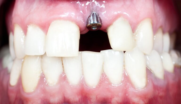 Implantes Dentales Sin Hueso O Con Poco Falta De Hueso Para Implantes