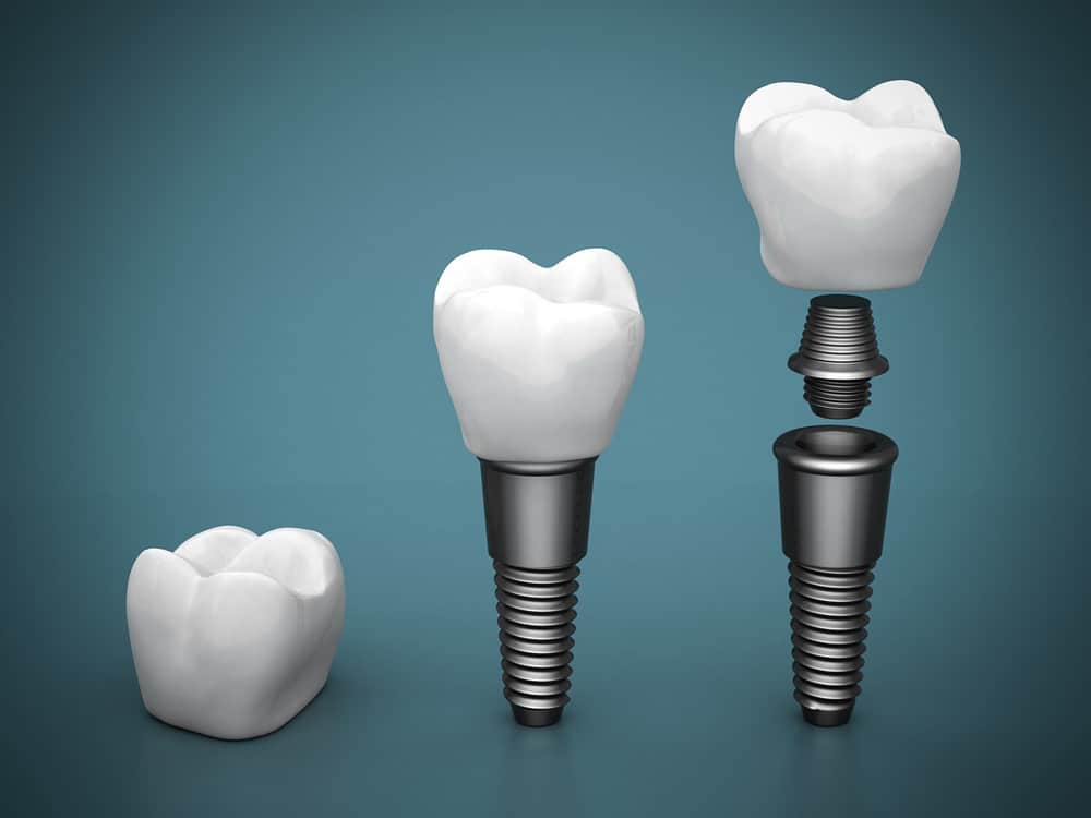 ¿cuáles Son Las Partes De Un Implante Dental Implante Y Corona