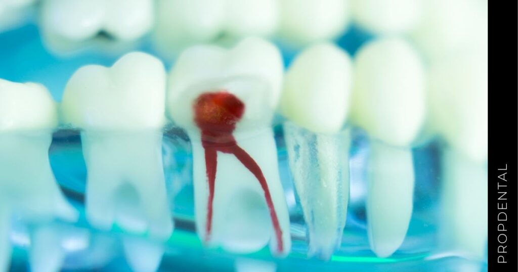 Pulpa Dental | El Nervio Del Diente