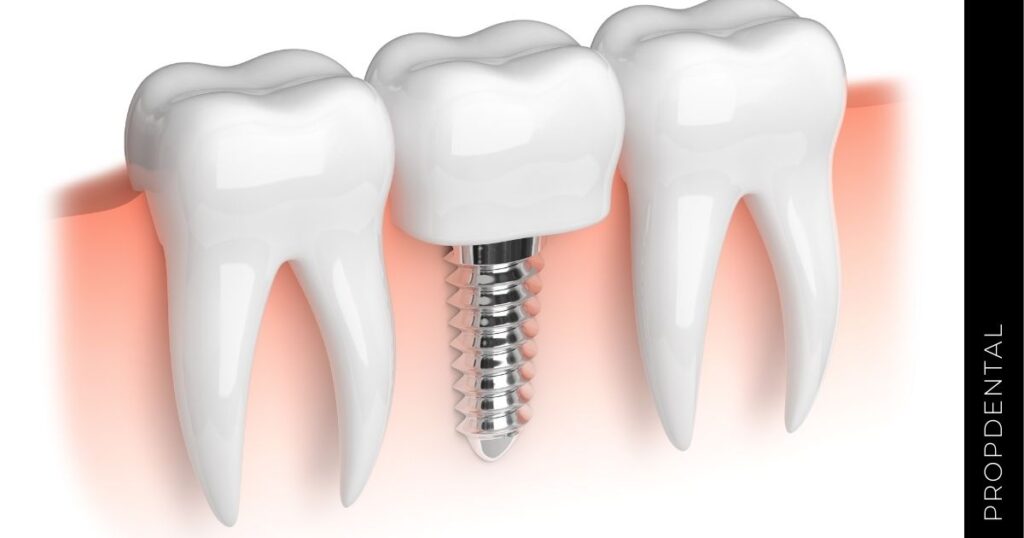 Fracaso De Implantes Dentales ¿qué Hacer Si Falla Un Implante Dental 8064