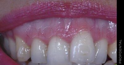 ¿Cuál es la causa de la aparición de la sonrisa gingival?