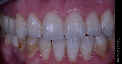 Fluorosis dental