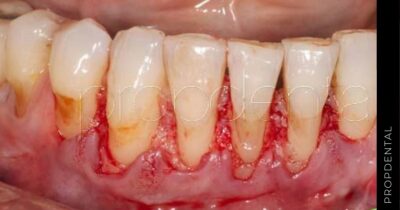 Injerto periodontal