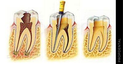 Particularidades de la pulpectomía